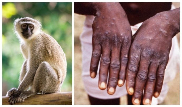 ВОЗ зафиксировала 780 случаев заболевания оспой обезьян в 27 странах